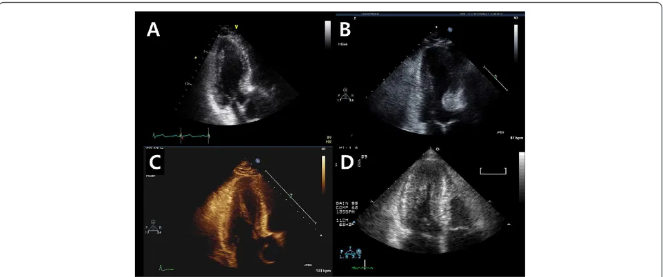 Figure 3 Representative case for each subgroup. Pure sigmoid septum (A), sigmoid septum with basal septal hypertrophy (B), prominentpapillary muscle (C) and small LV cavity due to concentric remodelling (D).