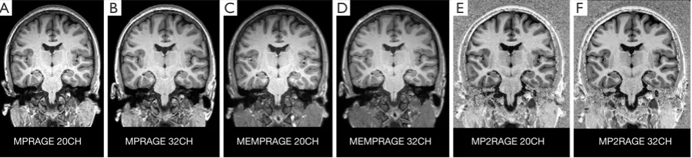 Figure 1 Overview of structural images from the same subject acquired with the (A) MPRAGE-20 channel, (B) MPRAGE-32 channel, (C) MEMPRAGE-20 channel, (D) MEMPRAGE-32 channel, (E) MP2RAGE-20 channel, and (F) MP2RAGE-32 channel combinations