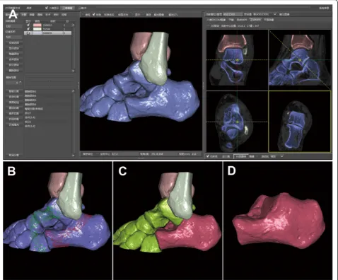 Figure 1 Process of generating the 3D structures of the calcaneus. (A) Joints of the hindfoot containing the subtalar joint, calcaneocuboidjoint and talonavicular joint combined with each other, which showed the blue clumps