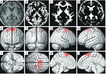 Table 1 The results of whole-brain volume analysis