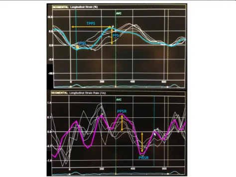 Figure 2 Left atrial longitudinal deformation and dyssynchrony measurements. Legend: Peak negative strain (PNS) and peak positive strain(PPS) were measured of each segment from baseline to the peak negative or peak positive value of longitudinal strain, re