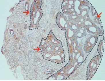 Figure 2 The example of image analysis of IHC staining in constructed TMAs. The area inside the dotted line belong to the colorectal epithelium (indicated by the red arrow)