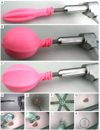 Figure 5 Surgical experiments of uterus dilatation and surgery: (A) dilator was inserted into the uterus; (B) dilatation balloon was filled with air; (C) ropes were tightened and the dilatation balloon was removed; (D) operating system is ready to be thrust into the dilator; (E) process of insert into the dilator; (F) operating system has reached the interior of uterus; (G) target has been found; (H) adjust posture of the end-effector; (I) end-effector is approaching to the target; (J) end-effector clamps the target; (K) target is successfully removed by the end-effector.