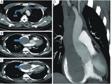 Figure 1 Pulmonary artery enhanced CT angiography (CTA) shows an anterior mediastinal mass and filling defects in the SVC and the LBV (A)