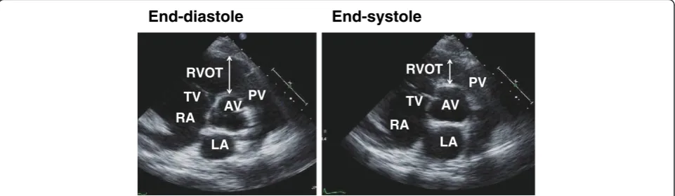 Figure 1 Two-dimensional view of right ventricular outflow tract at end-diastole and end-systole