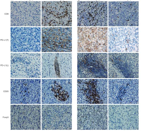 Figure 1 IHC analysis of CD8, PD-L1, CD20, and Foxp3 expression in paired STS between the 1st and 2nd surgery