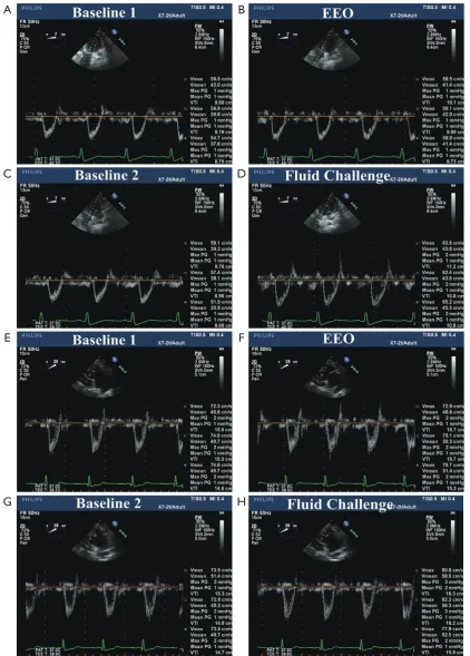 Figure 1 elocity-time integral of the left ventricular outflow tract at baseline, during an end-expiratory occlusion, and after fluid administration
