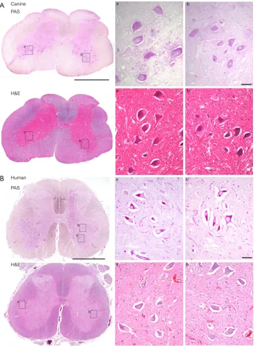 Figure 1 Lumbar spinal cord sections from an adult dog with early onset Pompe disease (A) and an adult human with late-onset Pompe disease (B)