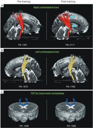 Figure 1 The change of the neural tracts on pre- and post-walnut training diffusion tensor tractography (DTT) in a 32-year-old female subject
