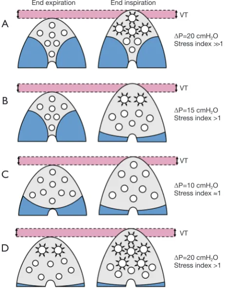 Figure 2 Effects on driving pressure and stress index of the application of the same tidal volume on lungs with different characteristics