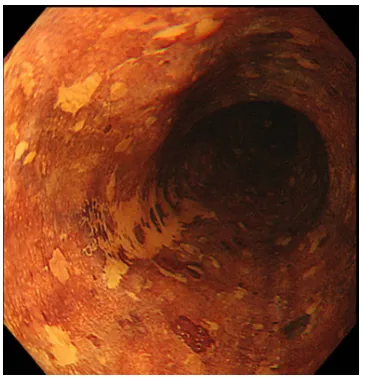 Figure 1 Flat SCC of the mid esophagus seen with Lugol staining and high-resolution endoscope