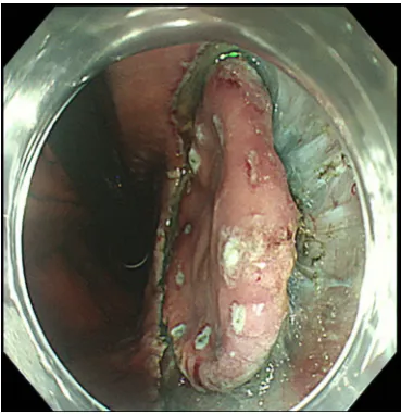Figure 3 Marking of SCC in the mid esophagus. SCC, squamous cell carcinoma.