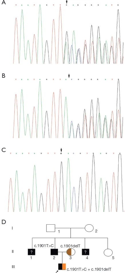 Figure 2 Genomic analysis (A,B,C) and pedigree chart (D) of the family. (A) GALC gene sequencing confirmed the compound c.1901delT and c.1901T>C mutations in the proband; (B) the heterozygous carrier state of c.1901delT in the mother; (C) the homozygous mu