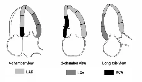 Figure 1coronary circulationThe different coronary artery beds and their representation in myocardial segments of the LV apical views, given a balanced The different coronary artery beds and their representation in myocardial segments of the LV apical view