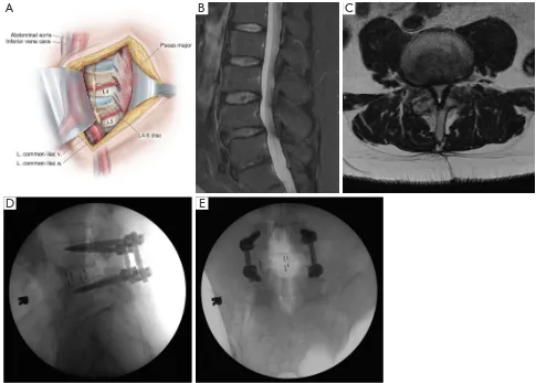 Figure 6 Overview of an oblique lumbar interbody fusion (OLIF). (A) Illustration of an OLIF exposure, with the medial portion of the psoas major muscle mobilized and retracted posteriorly to expose more of the disc space annulus