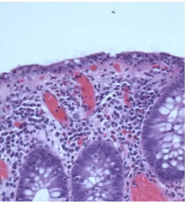 Figure 1 Collagenous colitis (HE, ×100).