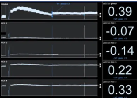 Figure 4 EIT waveforms (global impedance and regions-of-interest waveforms represented as four quadrants: anterior right (ROI 1), anterior left (ROI 2), posterior right (ROI 3), posterior left (ROI 4)