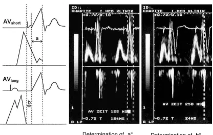 Figure 1determination of "b" for a nonphysiologically long AV interval (e.g. 250 ms)Ritter's method: The first step is determination of "a" for a nonphysiologically short AV interval (e.g