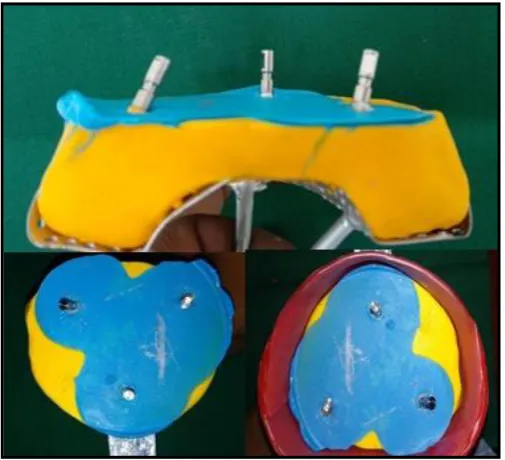 Figure 10: Die stone cast prepared from closed tray impression  
