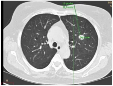 Figure 1 Screenshot of optimal route for CT guided biopsy with puncture site and angle estimation