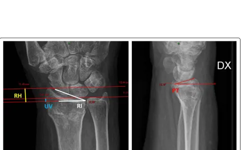 Fig. 1 Postero-anterior and lateral view radiographs showing extra-articular fractures of the distal radial epiphysis with dorsal displacement(type 2R3A2.2 according to the AO/OTA classification)