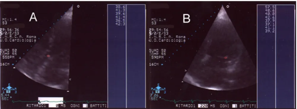 Figure 3Score 2. Panel A: AD of mitral valve (apical scan); Panel B: AD of aortic valve (parasternal scan: short axis)Score 2