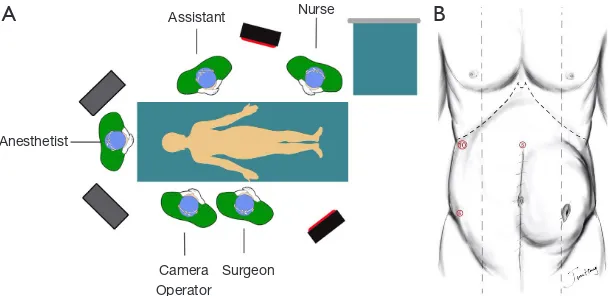 Figure 2 Surgical position and trocar placement. (A) Operating room layout; (B) trocar placement.