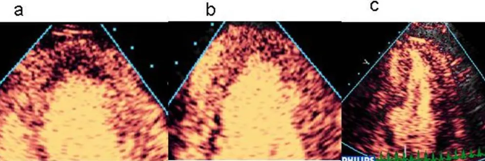 Figure 10Contribution of regional shape changes to the identification of perfusion defects, including irregular wall contour in the apex (a) and mid-inferior segment (b), both associated with subendocardial defects