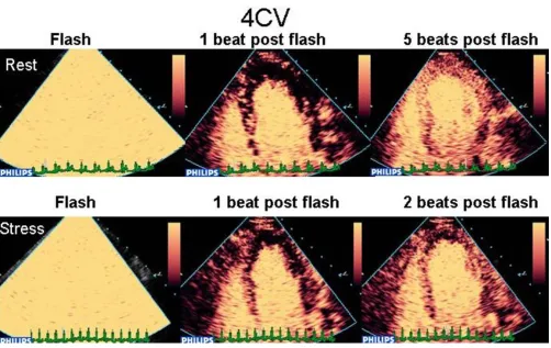 Figure 12ent with LAD stenosisA clear apical defect is evident 2 beats post flash at peak stress (bottom line) which was not evident at rest (top line), consist-A clear apical defect is evident 2 beats post flash at peak stress (bottom line) which was not 