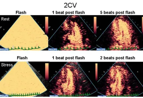 Figure 13stenosisA basal and mid inferior defect is evident 2 beats post flash at peak stress which was not evident at rest, consistent with RCA A basal and mid inferior defect is evident 2 beats post flash at peak stress which was not evident at rest, con