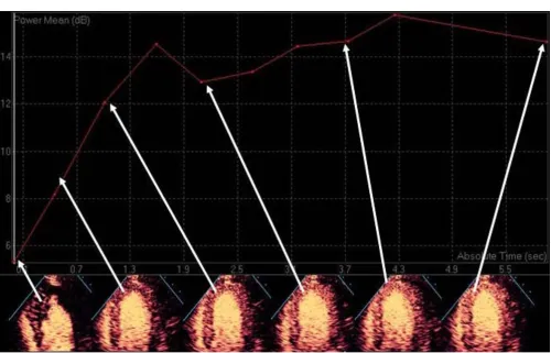 Table 3: Myocardial contrast echo studies with patients undergoing coronary angiography.