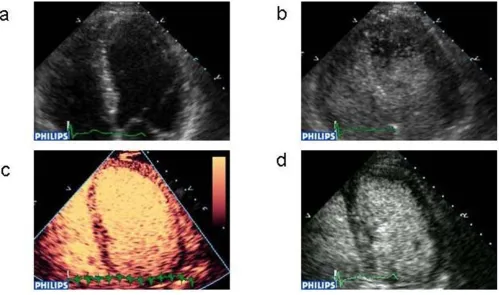 Figure 5Importance of machine settings for using contrast for LV opacificationImportance of machine settings for using contrast for LV opacification