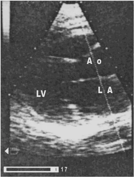 Figure 1Stress echocardiography: long axis view (baseline)Stress echocardiography: long axis view (baseline)