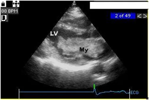 Figure 2Echocardiography (45 months) long axis viewEchocardiography (45 months) long axis view