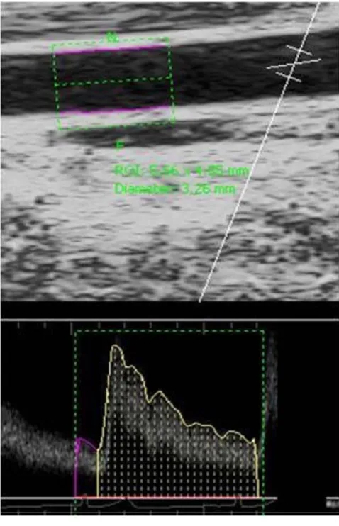 Figure 2subject immediately following cuff deflationdetection Brachial Analyzer software) of a representative Analysis of brachial diameter and velocity (using the edge-Analysis of brachial diameter and velocity (using the edge-detection Brachial Analyzer software) of a rep-resentative subject immediately following cuff defla-tion.