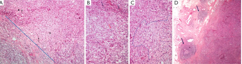 Figure 1 Examples of histopathologically assessed immune cell infiltrates and structures