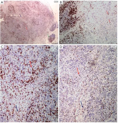 Figure 2 Examples of main tumor immune status markers, as assessed with immunohistochemistry
