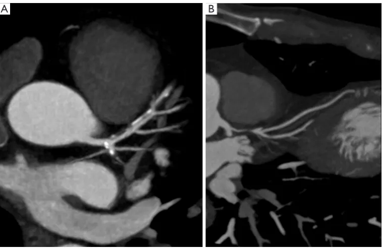 Figure 1 Curved multiplanar reformatted images of the (A) right coronary artery, (B) circumflex artery, (C) left anterior descending coronary artery