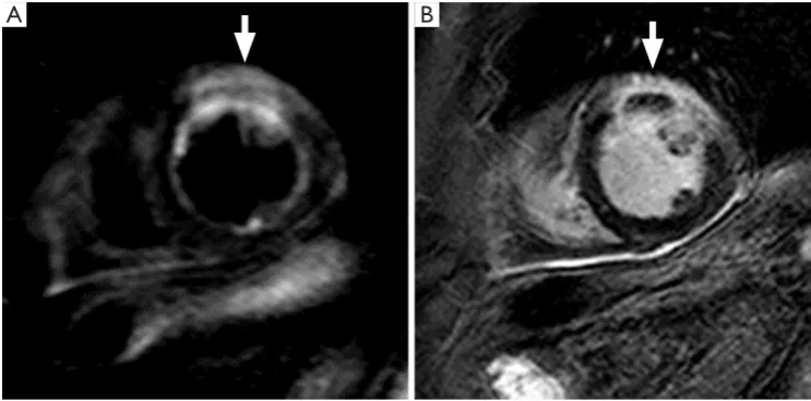 Figure 3 CMR images of an acute myocardial infarction; (A) T2w fat-suppressed image and (B) LGE image: region of T2w hyperintensity (A, arrow) of the anterior wall, which appears thickened, associated to LGE (B, arrow)