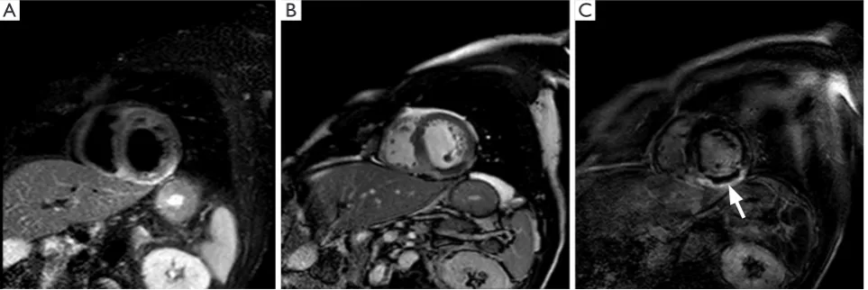 Figure 4 CMR images of an acute myocardial infarction; (A) T2w fat-suppressed image and (B) fisrts passage image and (C) LGE image: region of T2w hyperintensity (A) of the inferior wall and septum consistent with myocardial edema, associated to a region of