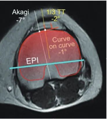 Figure 1 In this case, the Akagi line is 7° internally rotated, the 1/3 TT is 2° internally rotated and the Zimmer Nex-Gen tracing positioned following the “Curve-on-Curve” technique is 1° internally rotated respect to the EPI