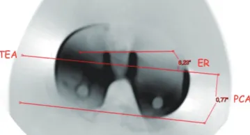 Figure 4 Left Knee. The rotational alignment of the symmetric tibial component (Nex-Gen, Zimmer, Warsaw, USA) is set matching the contour of the tibia anterior cortex (“Curve-on-Curve Technique”).