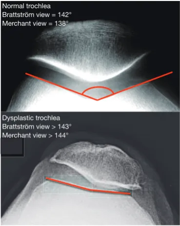 Figure 1 Illustration of trochlear sulcus angles measured on skyline radiographs in healthy and dysplastic knees.