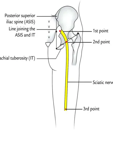 Figure : Surface Marking of Sciatic Nerve 