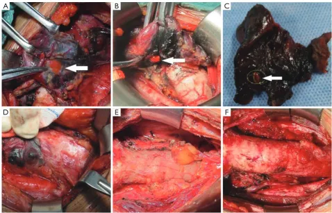 Figure 2 Types of parathyroid glands. (A) Type A1; (B) type A2; (C) type A3; (D) type B1; (E) type B2; (F) type B3