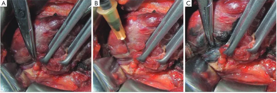 Figure 3 Additional injection of nano-carbon for the identification of parathyroid glands
