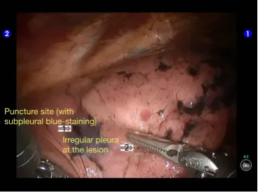 Figure 7 Removed the lesion from the auxiliary port device with endoscopic extract.