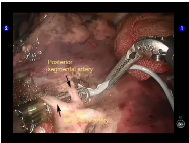 Figure 25 Thoroughly dissociate the superior branch of the posterior segmental artery.