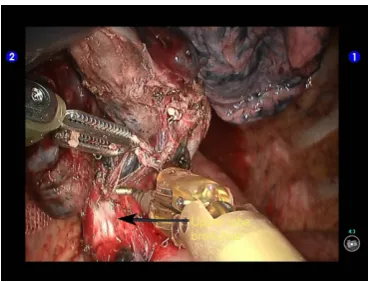 Figure 27 Thoroughly dissociate the apical anterior segmental artery.