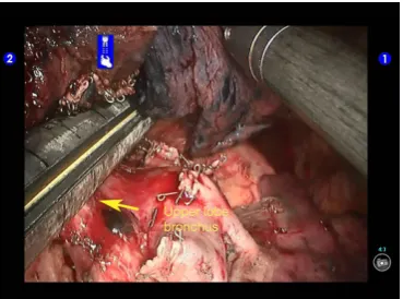 Figure 37 Placement of drainage tube: the thoracic drainage tube was indwelled at the working port at the 5th ICR and at the camera port, respectively.